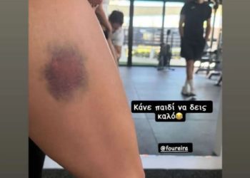 Ελένη Φουρέιρα: Η μελανιά «ενθύμιο» από τα παιχνίδια με τον μικρό Ερμή – «Κάνε παιδί να δεις καλό»